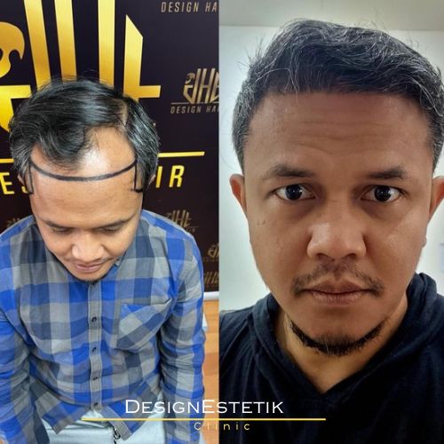 Hair transplant result 1