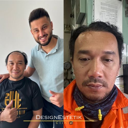Hair transplant result 2