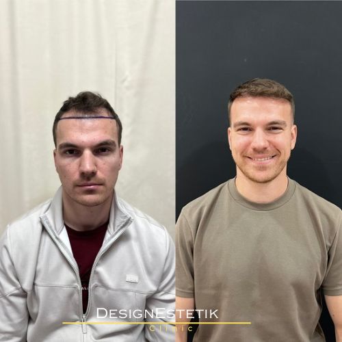 Hair transplant result 3