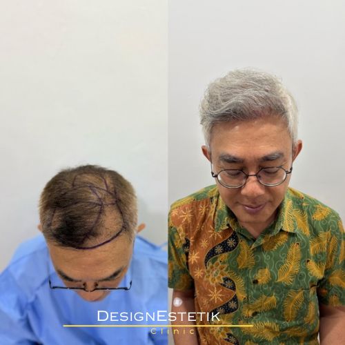 Hair transplant result 4