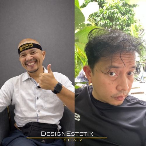 Hair transplant result 5
