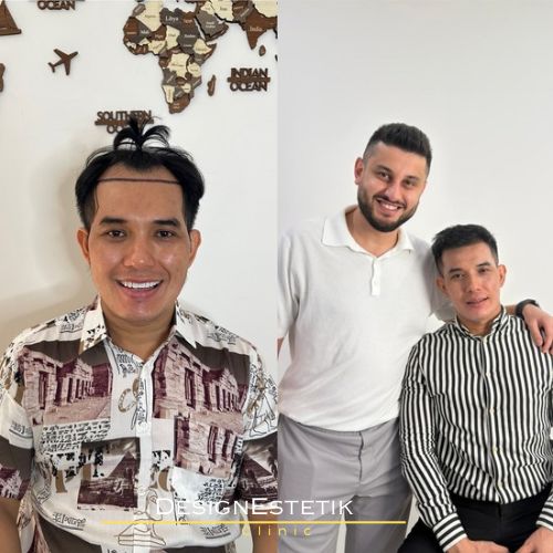 Hair transplant result 6