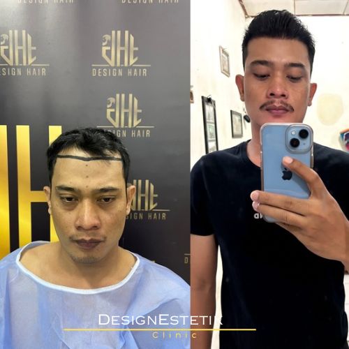 Hair transplant result 7