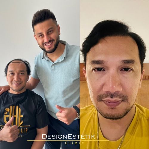 Hair transplant result 8